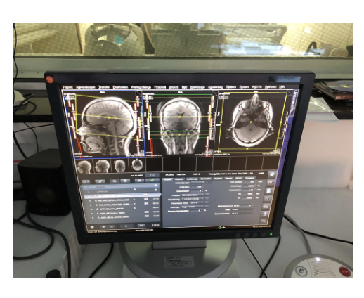 Im MRT sichtbar: Exzessives Fernsehen erhöht die Verknüpfung zwischen den visuellen und motorischen Lernnetzwerken im Gehirn.