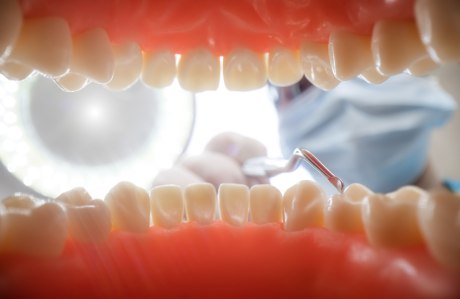 PAR-Vorbehandlung Zahnreinigung Blick aus dem Mund des Patienten