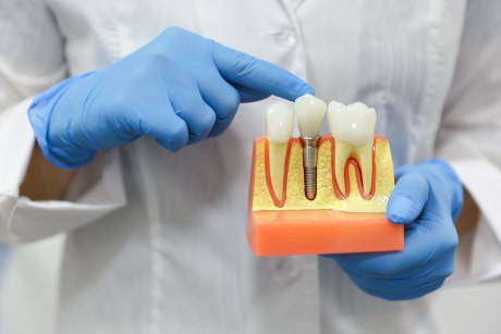 Modell eines implatantierten Zahnes in der Hand eines Zahnarztes