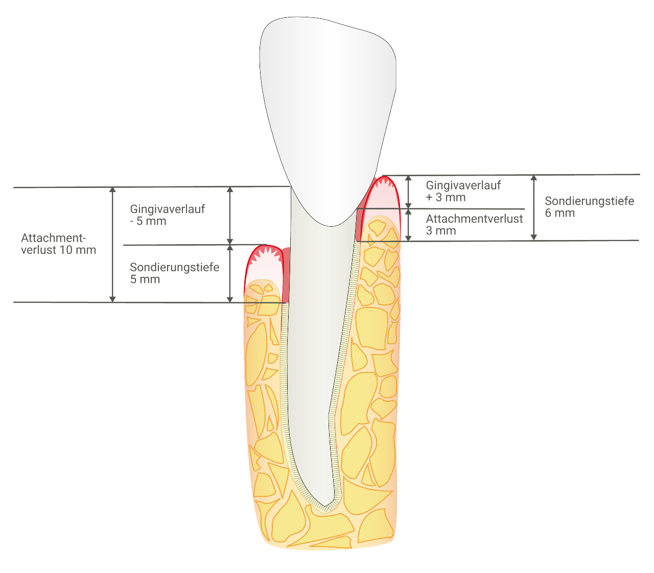 Um ein möglichst vollständiges Bild der parodontalen Situation zu erhalten, sollte immer an sechs Stellen pro Zahn gemessen werden. 