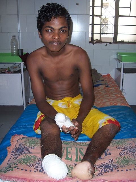 Frisch fußamputierter Lepra-Patient in der Lepra-Clinic Bubashnewar, Indien