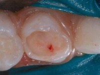 Abb. 2: Nach Exkavation des erweichten Dentins ist die Pulpa eröffnet. Vor dem Eingriff hatte die Patientin nur leichte Beschwerden.
