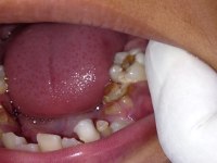 Mangelnde Mundhygiene
