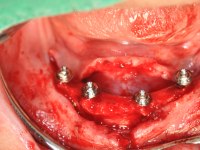 Abb. 2: Nach einer Knochennivellierung werden vier interforaminale Implantate für eine verschraubte Versorgung im Unterkiefer inseriert. An die Schleimhautdicke angepasste Abutments sind definitiv verschraubt.