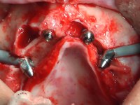 Abb. 7 und 8: Die Implantate werden in die laterale Corticalis des Os zygomaticum inseriert und sind bukkal zum Teil mit Weichgewebe bedeckt. Die Panoramaschichtaufnahme zeigt eine zusätzlich durchgeführte All-on-4-Versorgung des Unterkiefers.