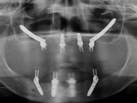 Abb. 8: Die Implantate werden in die laterale Corticalis des Os zygomaticum inseriert und sind bukkal zum Teil mit Weichgewebe bedeckt. Die Panoramaschichtaufnahme zeigt eine zusätzlich durchgeführte All-on-4-Versorgung des Unterkiefers.