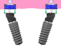 Abb. 4 und 5: Angulierte Implantate lassen sich auch für abnehmbare Ganzkieferversorgungen nutzen. Durch entsprechend abgewinkelte Abutments (Novaloc) lässt sich die Prothese leichter aus dem Mund entnehmen, der Abrieb zwischen Bauteilen wird zugleich reduziert.