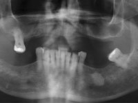 Panoramaschicht-Aufnahme mit elongierten Zahn 17