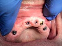 geöffneter Mund mit Implantaten