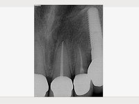 Röntgenbild von Zahn 14 mit Revisionsbedarf