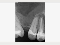 Röntgenaufnahme von Zahn 14 mit Längsfraktur