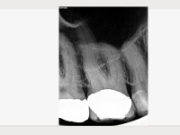 Pulpitischer Zahn mit röntgenologisch teilobliterierten Wurzelkanälen 