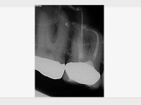 Pulpitischer Zahn mit röntgenologisch teilobliterierten Wurzelkanälen 