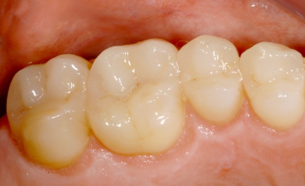 Klinisches Ergebnis für presskeramische Kronen und Teilkronen nach 19 Jahren (Zähne 14 bis 17). 