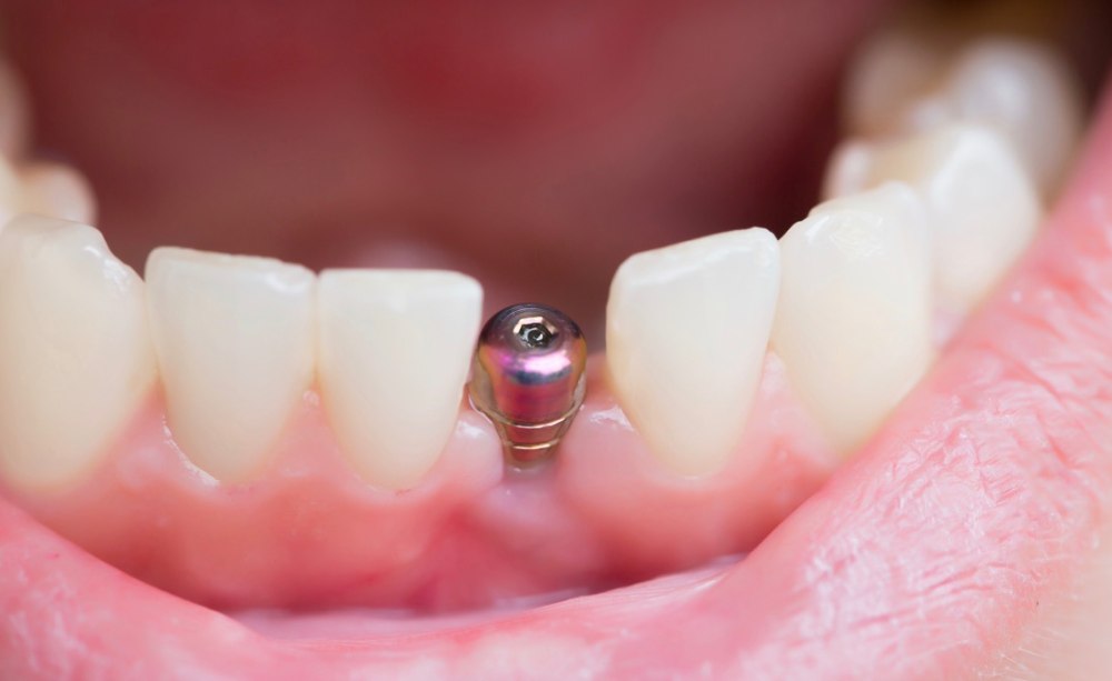 Zahnnichtanlage_Implantat