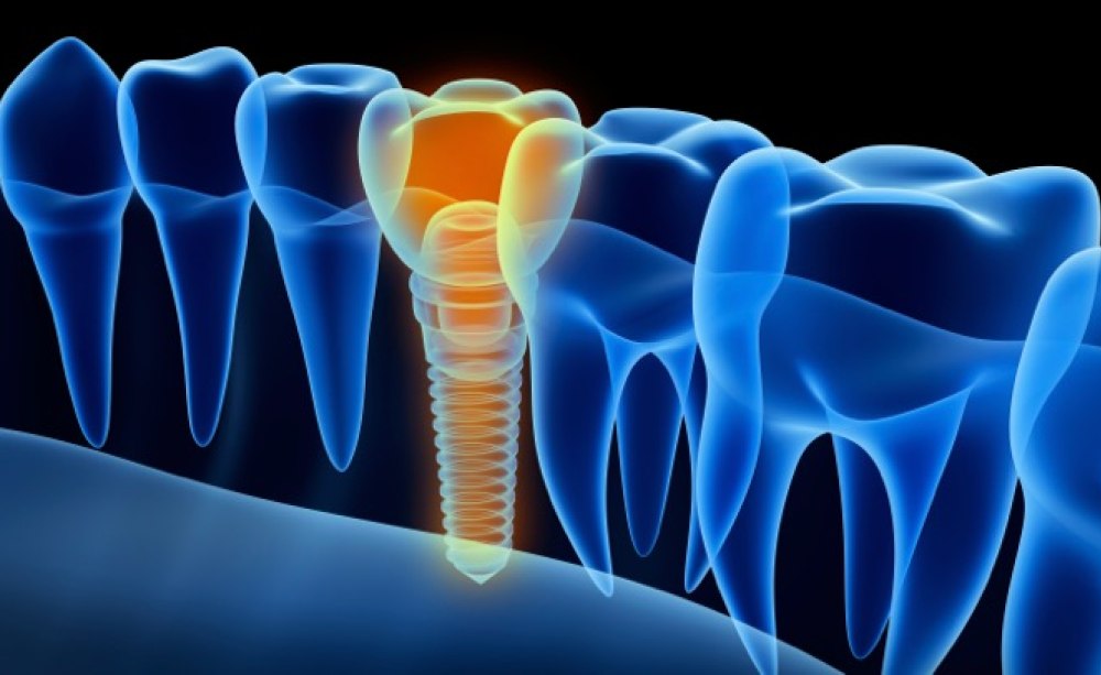 Grafische Darstellung eines Implantats im Stile eines Röntgenbildes