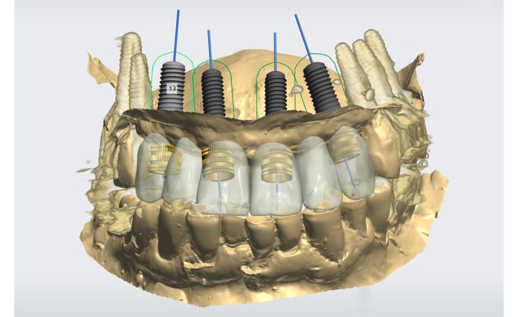Trend 3D-Implantatplanung, DICOM meets STL