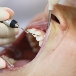 Parodontitis und Diabetes hängen eng miteinander zusammen. Ein neuer Behandlungsleitfaden für Zahnärzte soll Ende Juli 2017 erscheinen.