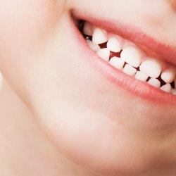 Milchzähne endodontisch zu behandeln ist keine Selbstverständlichkeit. Mit Pulpotomien lassen sich Milchmolaren aber relativ einfach erhalten. 