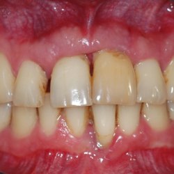Bakterielle, strukturierte Plaque kann besonders in schwierig zu reinigenden Zahnregionen zu parodontalen Entzündungen führen