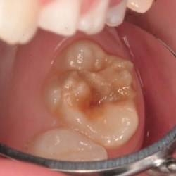 Ein MIH-Zahn (26) mit brauner scharf begrenzter Opazität okklusal und posteruptiver Schmelzfraktur der distobukkalen Höckerspitze