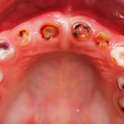 Abb. 4: Schwere Form der Frühkindlichen Karies (ECC) mit zahlreichen tief zerstörten Zähnen, die wie hier nicht nur an den Oberkieferfrontzähnen, sondern auch an den Milchmolaren auftrifft. Zum Teil sind wie an den Zähnen 65 und 51 bereits Abszedierungen zu befunden. Der Gebisszustand kann abhängig von der Kooperation des Kindes eine Zahnbehandlung in Narkose indizieren. 