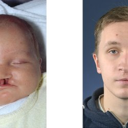 Der Patient mit Lippen-Kiefer-Gaumenspalte im Alter von zwei Wochen und 20 Jahren