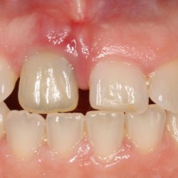 Alveolarknochen wächst als Teil des Zahnhalte-Apparates nicht weiter: Zustand drei Monate nach Trauma bei einem 12-jährigen Jungen, der avitale Zahn 11 wurde in der Folge durch ein Implantat ersetzt.