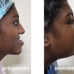 Links: Vor der Operation, Rechts: Nach der Operation