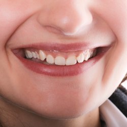 Patientin mit leichter Zahnfehlstellung 