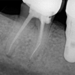 Zahn 47 und Implantat an Position 46 