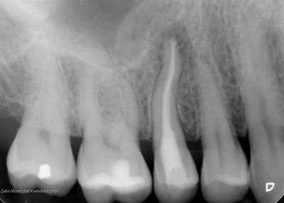 Röntgenbild Zahnwurzel