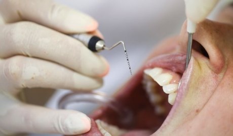 Ein Bild, das einen geöffneten Mund und eine Hand mit Gummihandschuh und einem zahnmedizinischem Instrument