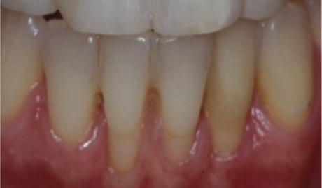 Im Ausgangsbefund erkennt man sechs Millimeter tiefe Rezessionen an den Zähnen 32 bis 42 bei sehr zartem marginalem Gewebe und Fehlen von befestigter (attached) keratinisierter Gingiva.