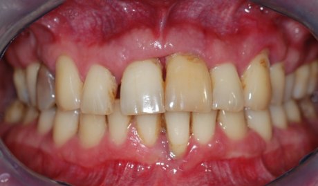 Bakterielle, strukturierte Plaque kann besonders in schwierig zu reinigenden Zahnregionen zu parodontalen Entzündungen führen
