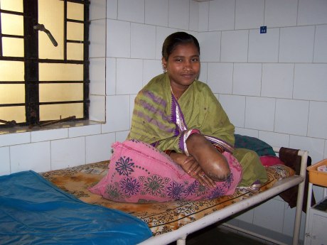 Lepra-kranke indische Frau zeigt amputiertes Bein
