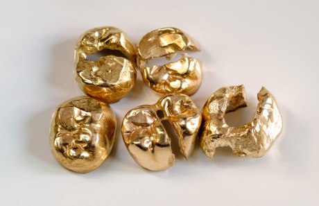 Zahnersatz aus Gold