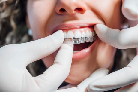 Ein Bild, das einen geöffneten Mund und Finger in Gummihandschuhen, die eine zahnkorrigierende Plastikzahnsachiene in den Mund setzen, zeigt