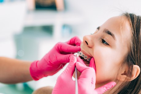 Ein Bild, das den Kopf eines neunjährigen Mädchens im Profil zeigt. Sie hat den Mund leicht geöffnet und trägt Brackets an den Zähnen, die von zwei Händen mit rosa Gummihandschuhen mit einem kieferorthopädischen Instrument untersucht werden.