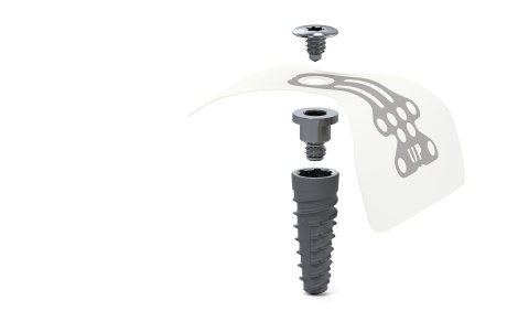 Implantataufbau mit Platzhalter, Membran und Deckschraube