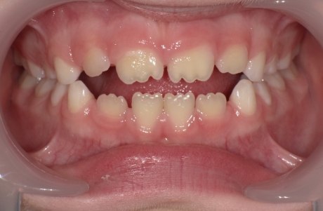Kinderzähne im geöffneten Mund durch Wangenhalter 