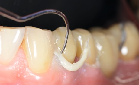 Überflüssiges Komposit am Zahnhals wird entfernt