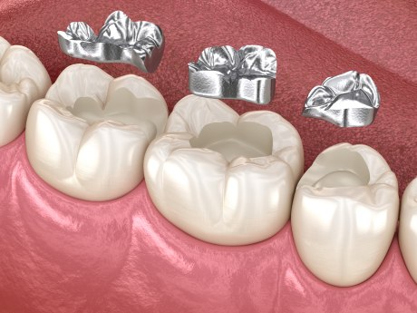 Amalgam-Restauration. Medizinisch genaue 3D-Animation des Zahnkonzepts