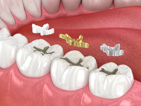 3D-Zeichnung drei verschiedener Zahnfüllungen im Mund