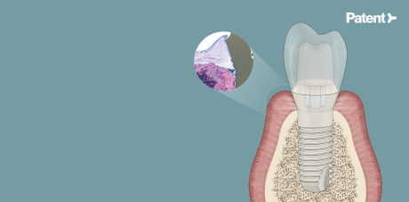 Zeichnung eines Querschnitts eines Implantats