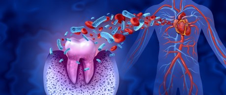 Ein grafisches Bild, das links einen entzündeten Zahn zeigt, der rote Blutplättchen und Krankheitserreger  zu einem Körper mit Blutgefäßen streut