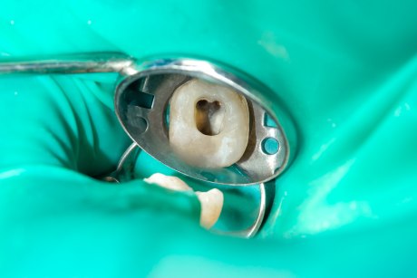 Nahaufnahme eines menschlichen kariösen Zahns in der Behandlungsphase in einer Zahnklinik