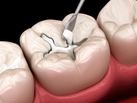 Zahnreihe und Zahnmaterialien
