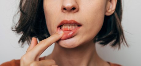 Frau hält mit Finger die untere Lippe herunter, zeigt Zahnfleischentzündung. Man sieht nur den halben Kopf und etwas Hals und Schultern