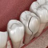 gespaltener Zahn in medizinischer 3-D-Illustration